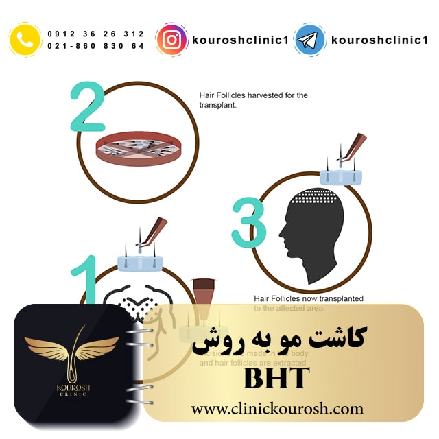 کاشت مو به روش BHT